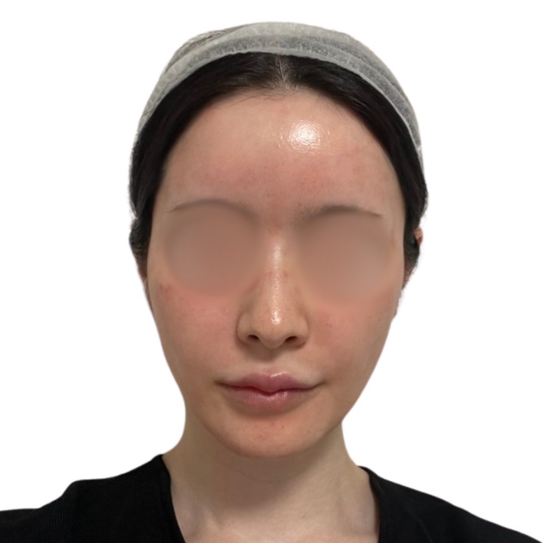 エクソソームフェイシャル